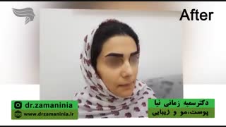 کاشت ابرو به سبک جدید