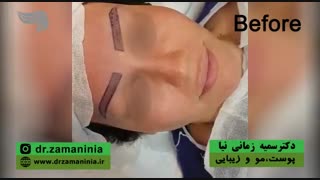 روش جدید کاشت ابرو