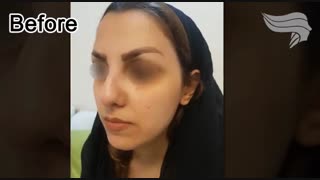 بهترین روش کاشت ابرو کدام است؟