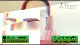 کاشت ابرو به سبک اروپایی