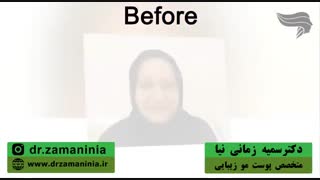 کاشت ابروی طبیعی
