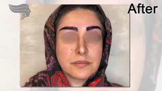 راه حل پرکردن ابرو