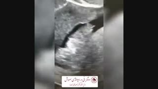 فیلم هیستروسونوگرافی