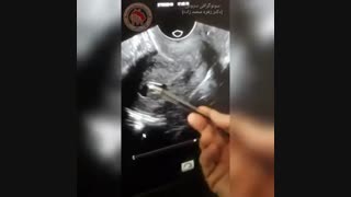فیلم هیستروسونوگرافی