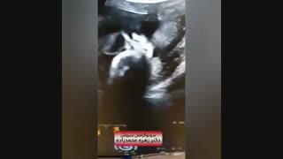 فیلم سونوگرافی صورت جنین دختر