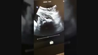 فیلم سونوگرافی صورت جنین