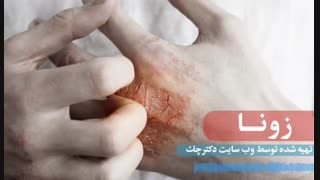 علت و روش درمان بیماری زونا یا shingles