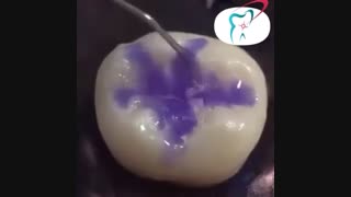 فیشور سیلانت یا شیار پوش