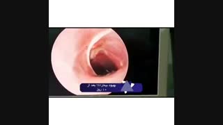 بهبود بیمار TEF بعد از 10 سال