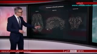 احیا مغز 4 ساعت پس از مرگ