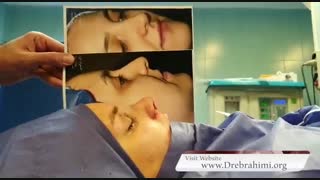 جراحی بینی نیمه فانتزی توسط دکتر امید ابراهیمی، بهترین جراح بینی