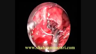 برداشتن پولیپ کولون بطریقه آندوسکوپیک بروشTEM