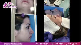 عمل زیبایی بینی توسط دکتر کاوان