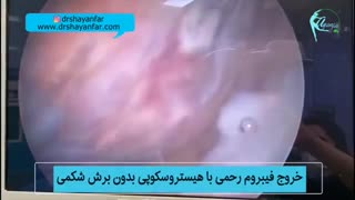فیلم عمل جراحی خارج کردن فیبروم رحم بدون برش شکمی
