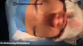 بلافاصله بعد از جراحی زیبایی بینی