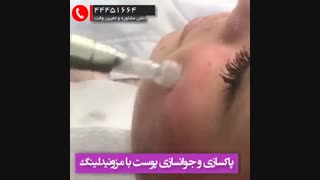 مزونیدلینگ