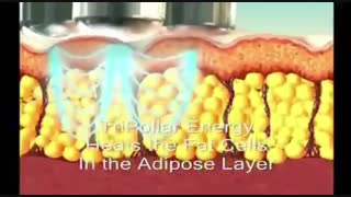 کرایولیپولیز