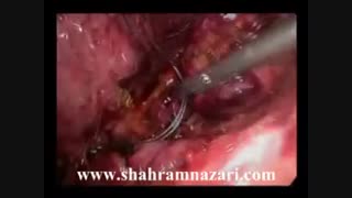 گزارش مصور یک مورد کله سیستکتومی لاپاروسکوپیک مشکل که تابحال ندیده اید