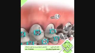 مینی اسکرو | دکتر لادن طیبی