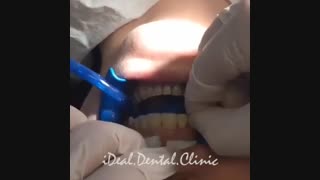 اصلاح طرح لبخند با استفاده از لمینیت سرامیکی | کلینیک ایده آل