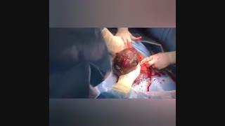 عمل زایمان سزارین بدون سانسور