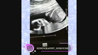 فیلم سونوگرافی صورت جنین پسر