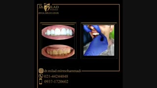 لمینت سرامیکی دندان