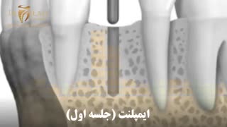 ایمپلنت دندان در جلسه اول