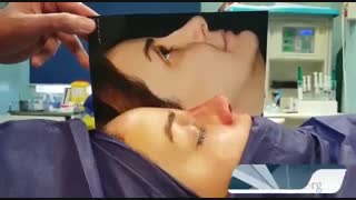 عمل ترمیم بینی با غضروف گوش توسط دکتر امید ابراهیمی بهترین جراح بینی