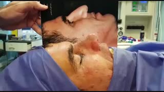 جراحی بینی گوشتی توسط بهترین جراح بینی دکتر امید ابراهیمی