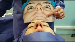 جراحی بینی گوشتی توسط بهترین جراح بینی گوشتی، دکتر امید ابراهیمی