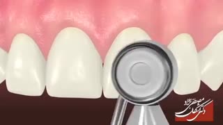 کاندیدای مناسب برای ونیر کامپوزیتی | دکتر اشکان مصطفی نژاد