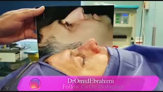 عمل بینی گوشتی توسط بهترین جراح بینی گوشتی دکتر امید ابراهیمی