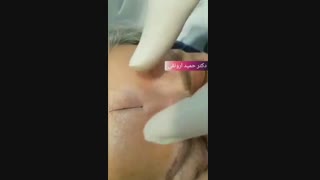 ویدیویی از رفع خط اخم با فیلر هیالورونیک اسید♦
