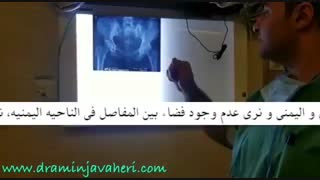 عملیه استبدال مفصل الحوض