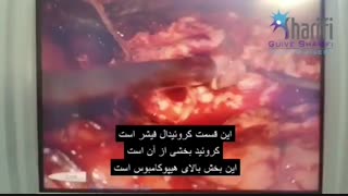 فیلم جراحی تومور مغزی در فرد مبتلا به صرع
