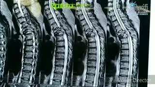 فیلم جراحی ستون فقرات