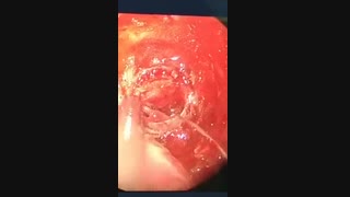 فیلم عمل جراحی آدنوم هیپوفیز در سال جدید