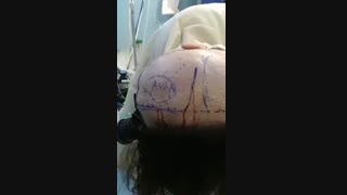 فیلم عمل ضایعه عروقی مغز در خانم جوان