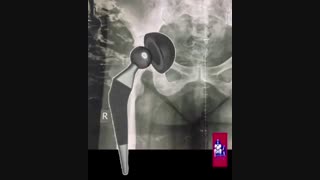 تجربه جراحی تعویض مفص لگن از زبان بیمار