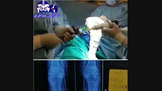 فیلم جراحی تعویض مفصل زانو در فرد جوان مبتلا به آرتریت