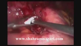 برداشتن لاپاروسکوپیک گاستریک باند (حلقه معده)