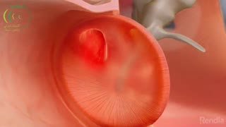 کلستئاتوما