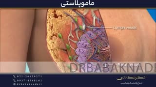 انیمیشن ماموپلاستی