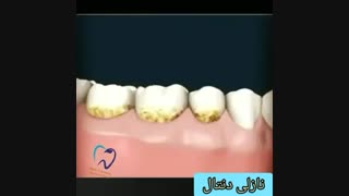 فیلم جرم گیری دندان