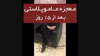 رضایت یکی از مراجعه کنندگان عزیز بعد از ماموپلاستی