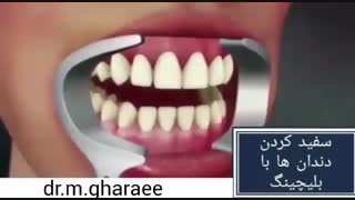 سفید کردن دندان با بلیچینگ رادیوگرافی دندان
