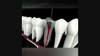 مراحل درمان ریشه دندان