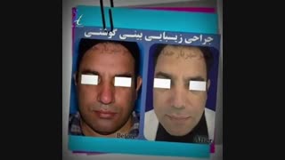 جراحی زیبایی بینی