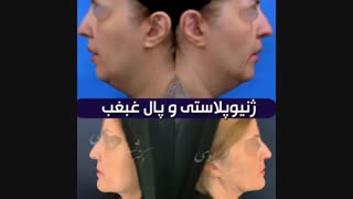ژنیوپلاستی و پال غبغب